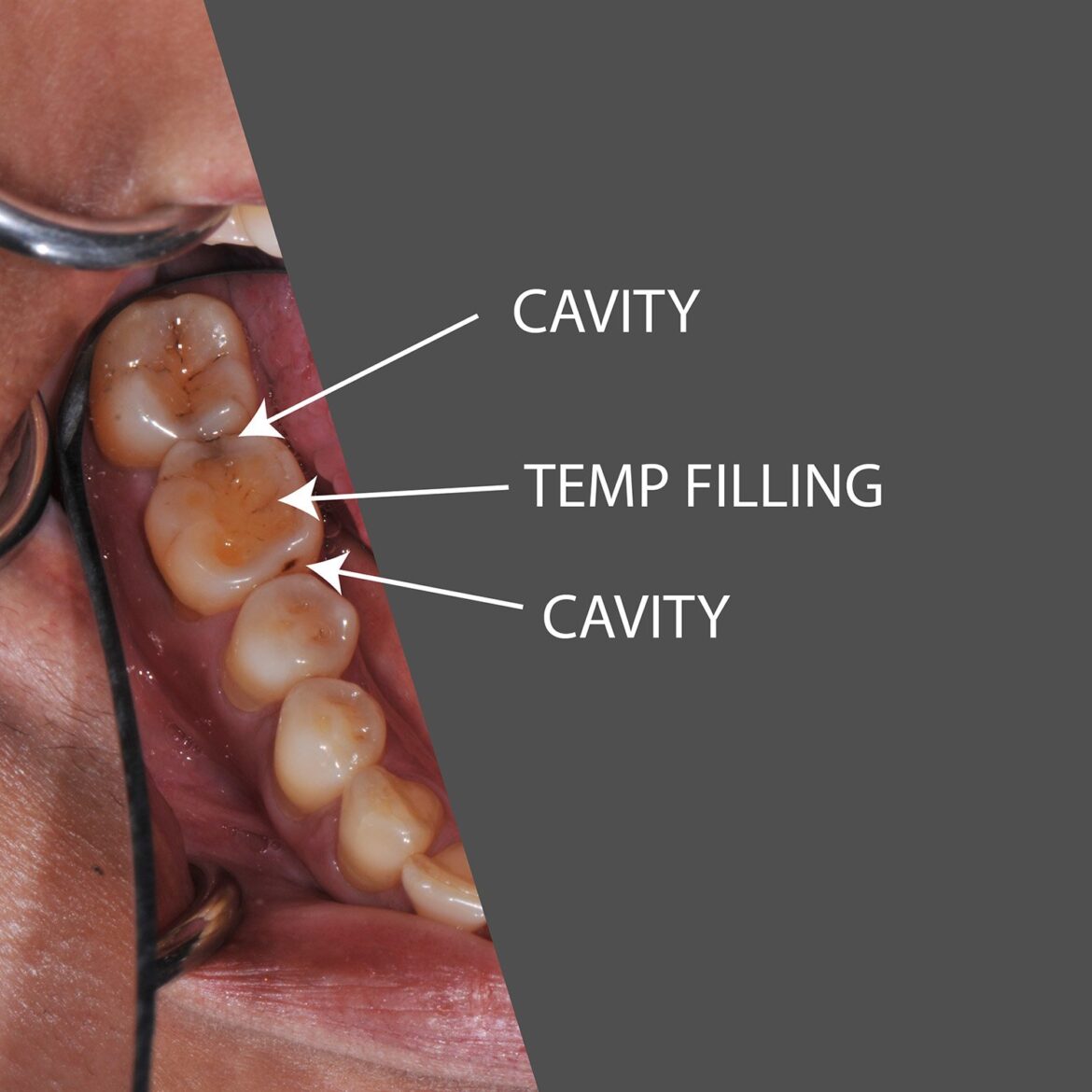 Exploring: How Long Does A Cavity Filling Take?